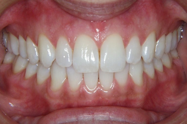 Bad Gum Health How it can affect your whole body Horsford